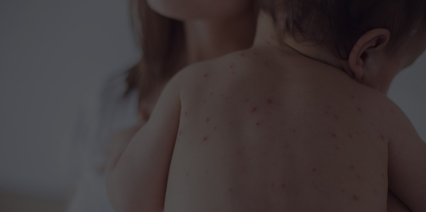 Measles (Rubeola)